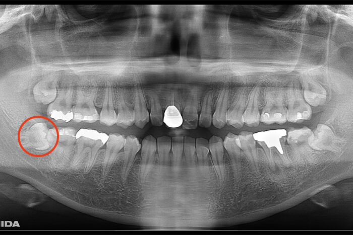 抜歯後の腫れ